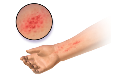 Why Does Skin Become Red and Irritated?