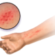 Why Does Skin Become Red and Irritated?