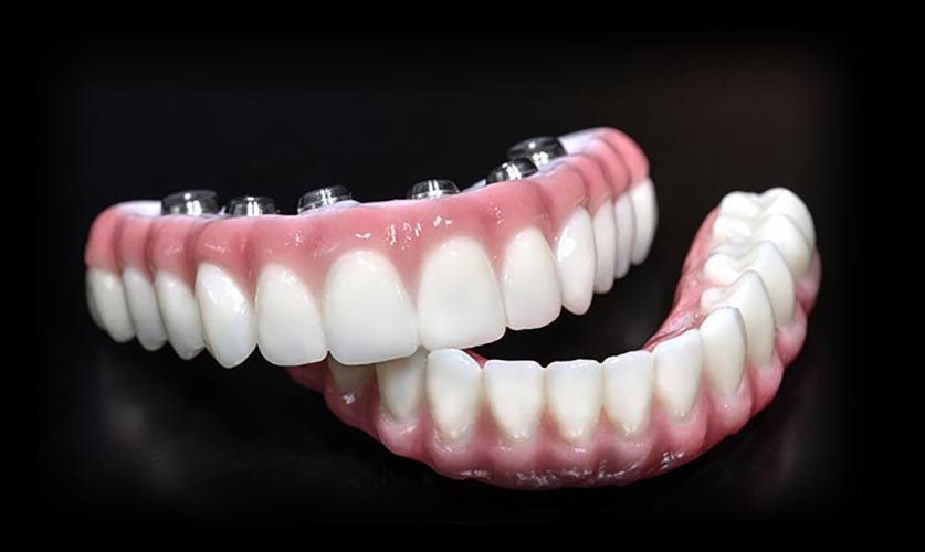 Comparing Dentures and Fixed Full-Arch Tooth Replacement